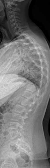 KİFOZ : Her Yaşın Problemi !