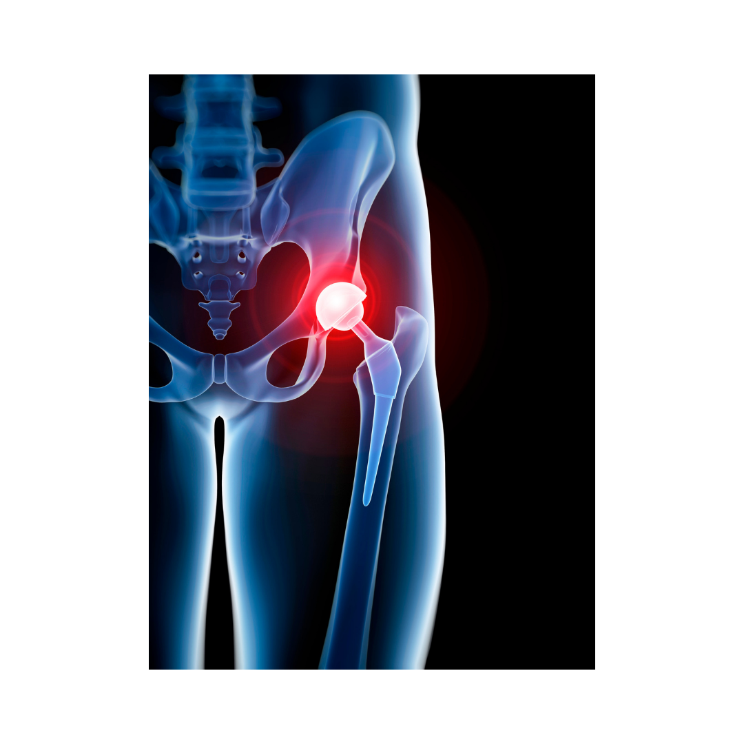 KALÇA VE DİZ PROTEZİ SONRASI REHABİLİTASYON